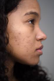 Is Accutane safe to use if you have acne?